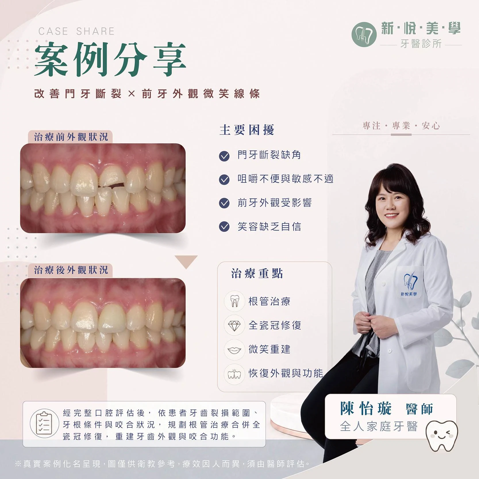 門牙斷一半還能保留嗎？認識根管治療與全瓷冠修復
