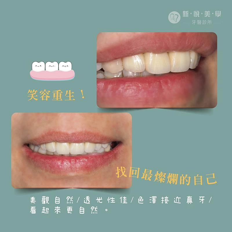 廣播DJ靜雯10年全瓷冠暗沉大翻新！