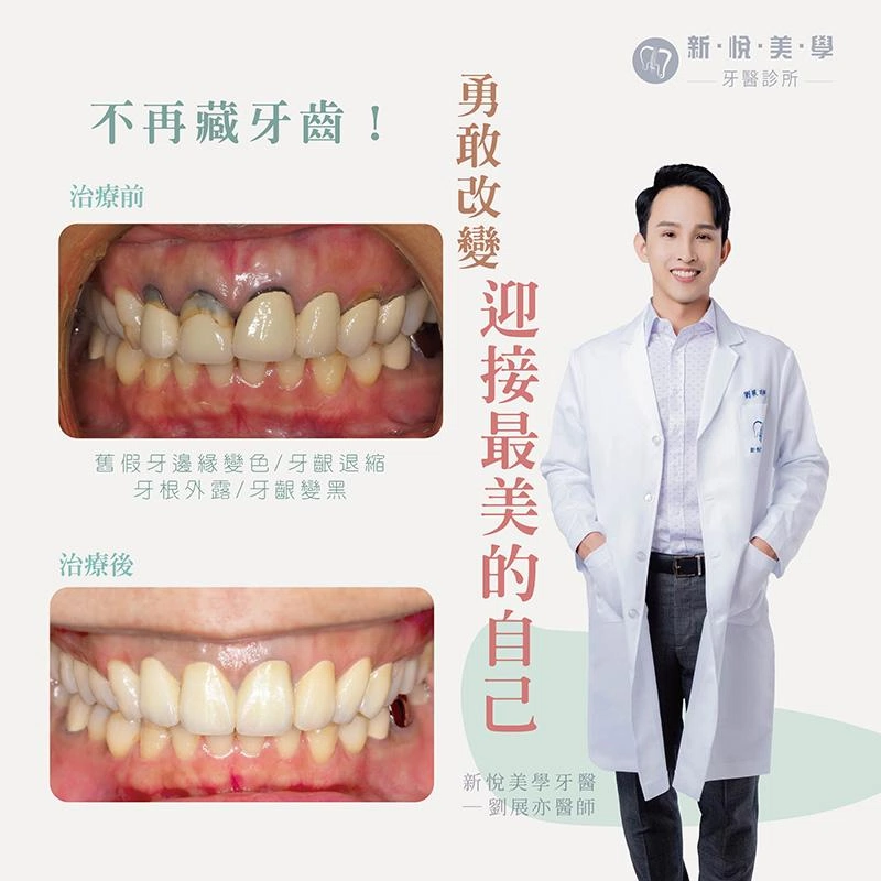 廣播DJ靜雯10年全瓷冠暗沉大翻新！