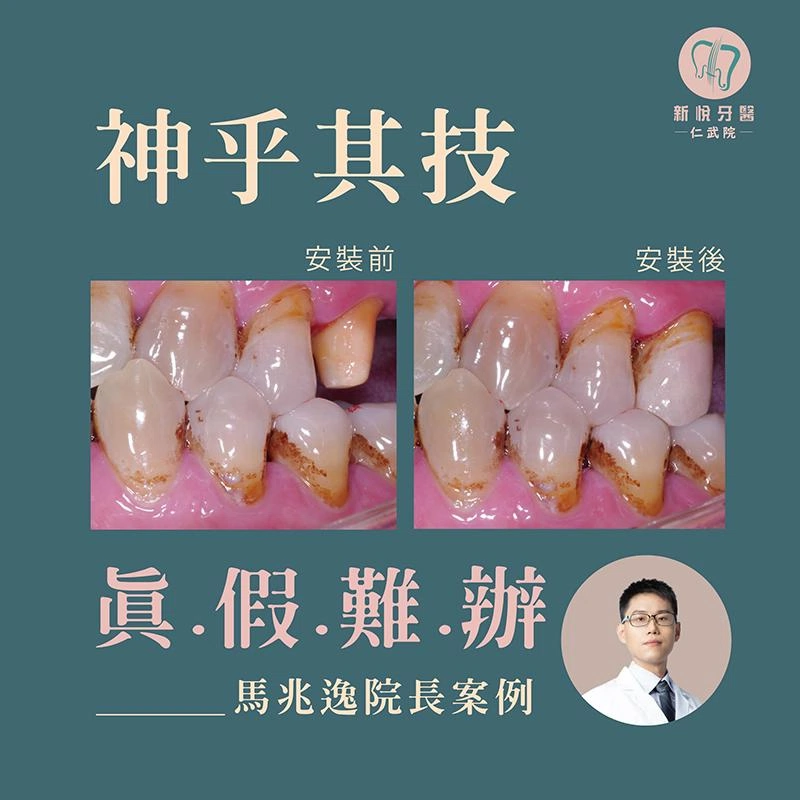 什麼是真？ 我們的牙技師，連你牙齒上的菸垢都能細緻重現喔！