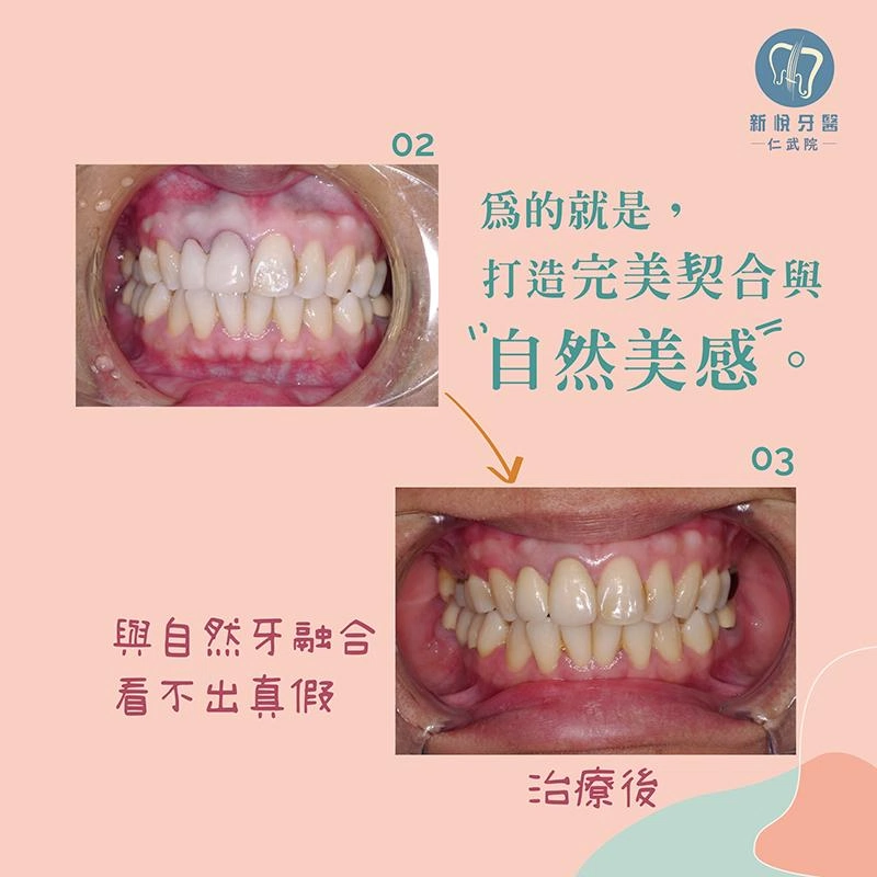 全瓷冠的誕生：從臨時假牙到自然微笑的精緻過程