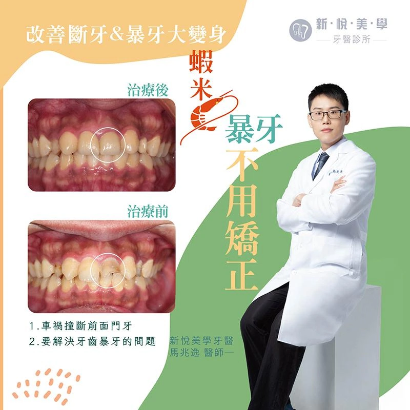 蝦米 ! 暴牙不用矯正，全瓷牙冠，一舉兩得！