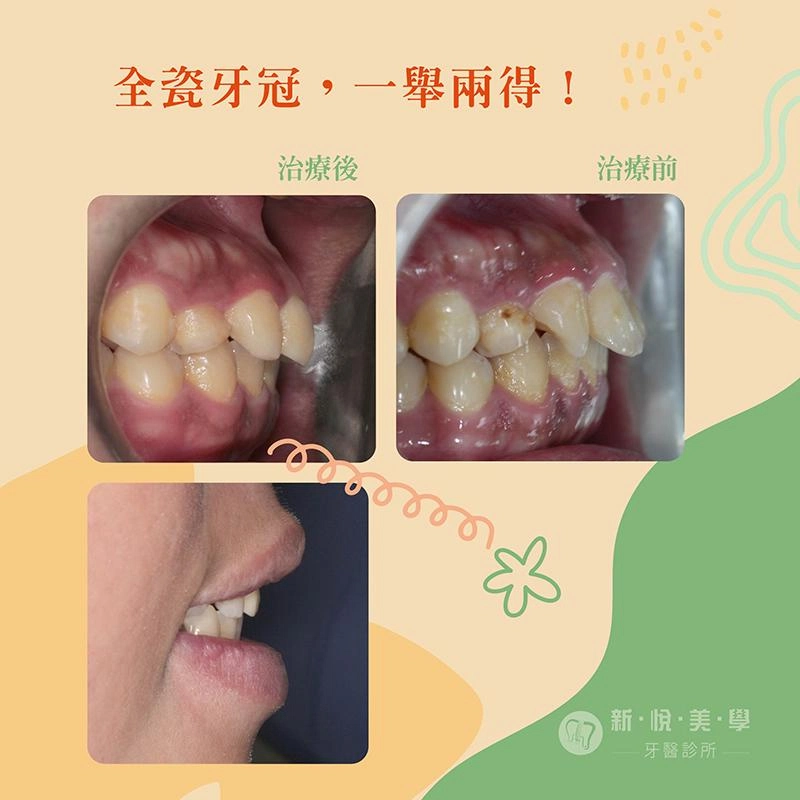 蝦米 ! 暴牙不用矯正，全瓷牙冠，一舉兩得！