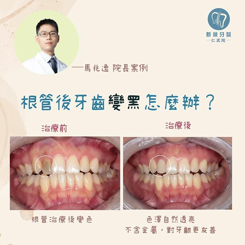 Oppa前牙變黑救星 — 全瓷冠修復