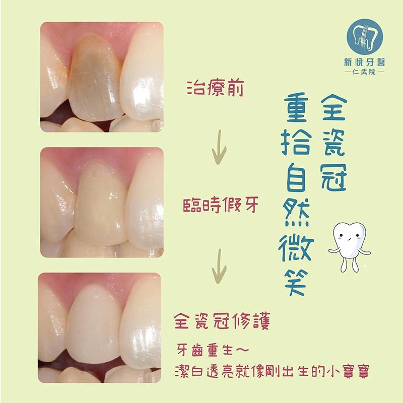 Oppa前牙變黑救星 — 全瓷冠修復