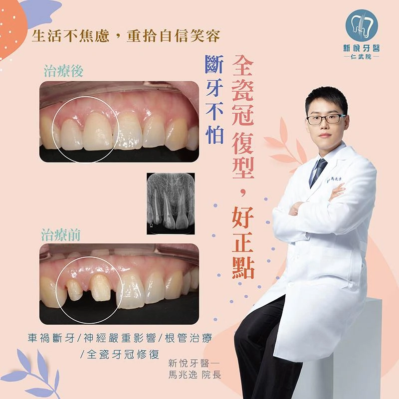 斷牙不怕， 全瓷冠復型，好正點