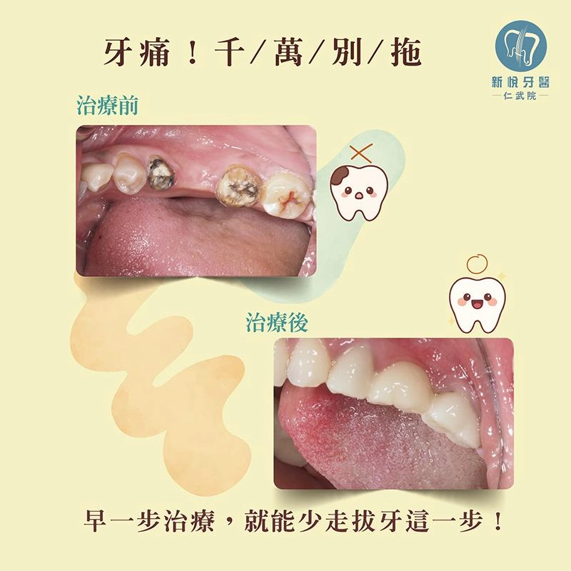 牙痛拖太久,差點只能拔牙? 牙痛拖太久,差點只能拔牙?