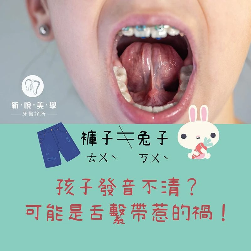 孩子發音不清？小心是舌繫帶在作怪！