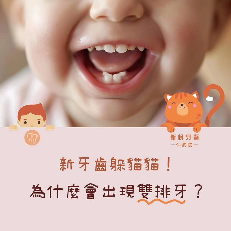 小朋友出現「雙排牙」怎麼辦？兒童牙醫完整解析