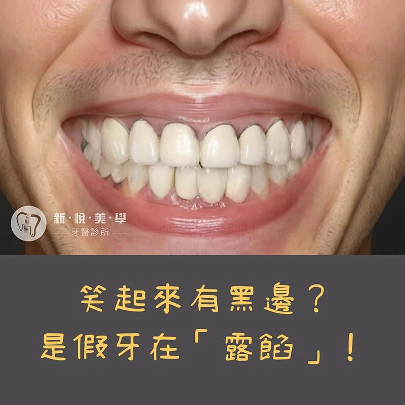 牙齦一圈黑？小心是假牙在露餡