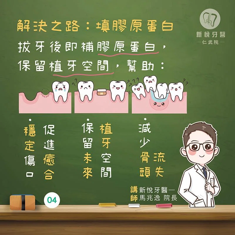 拔牙後不植牙會怎樣?骨頭流失的3大後果 拔牙後不植牙會怎樣?骨頭流失的3大後果