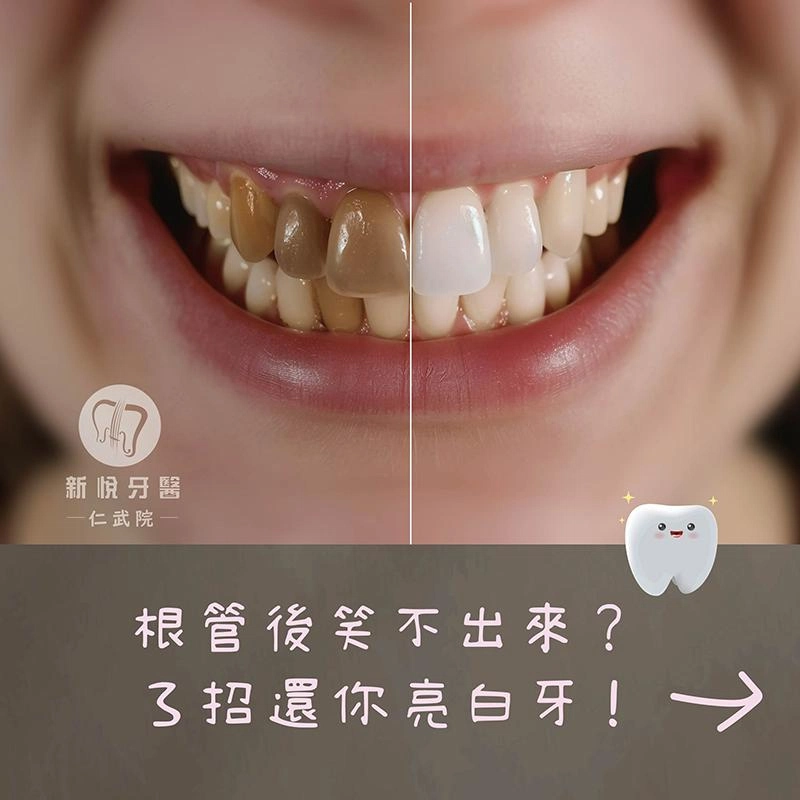 根管後笑不出來？3 招還你亮白牙！