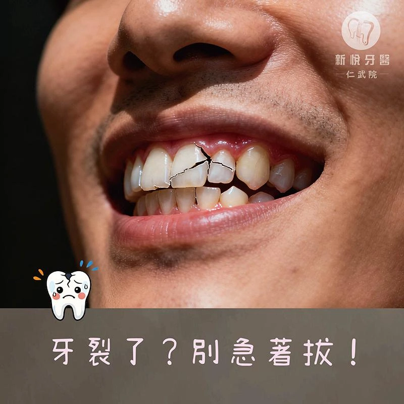 牙裂了，就一定要拔嗎？其實還有機會留下來
