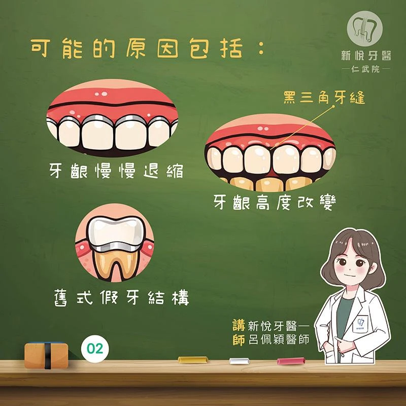 假牙黑邊怎麼來的?牙齦退縮是關鍵之一 假牙黑邊怎麼來的?牙齦退縮是關鍵之一