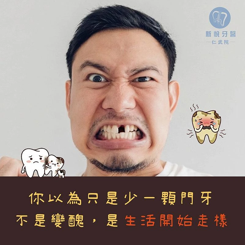 門牙缺失怎麼辦？缺牙對發音、咀嚼與笑容的影響一次看懂