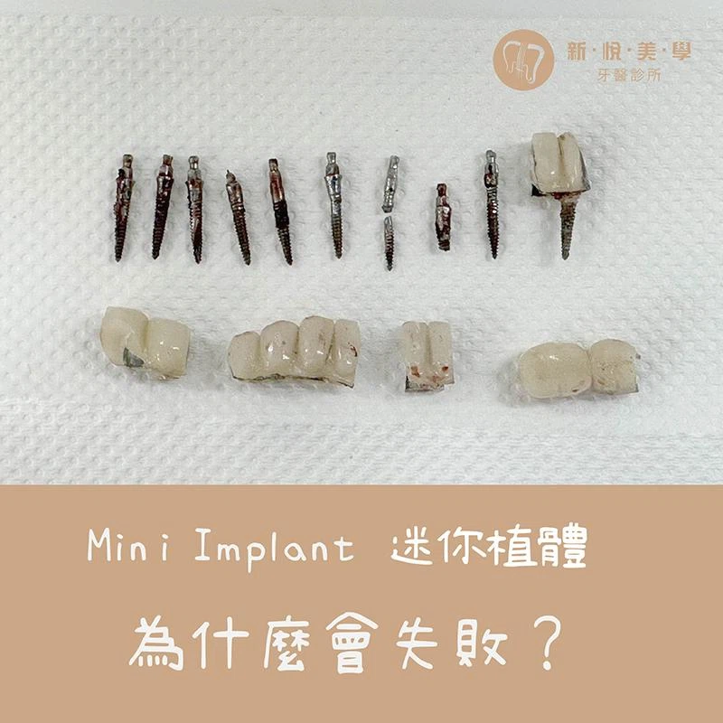 Mini Implant 為什麼會失敗？迷你植體適合長期植牙嗎？