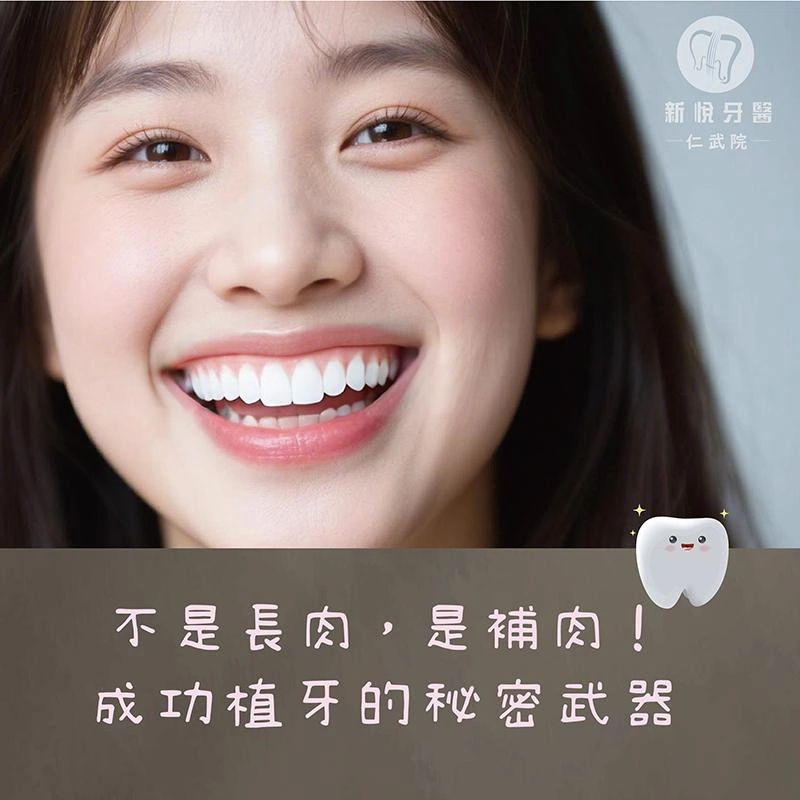 牙齦也能「補肉」？牙齦移植手術大解析！