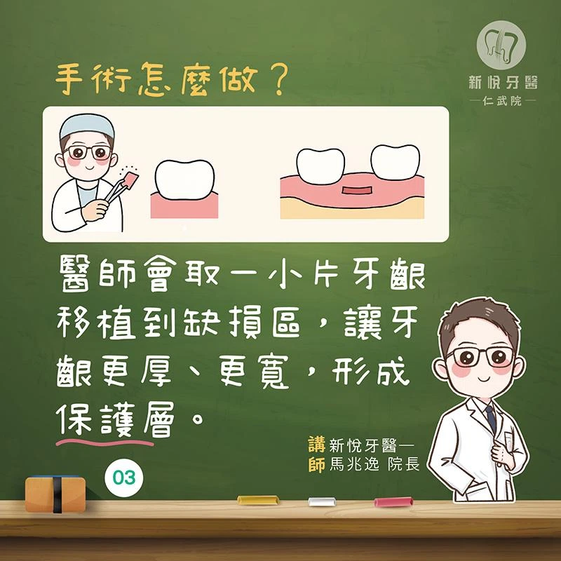 牙齦也能「補肉」?牙齦移植手術大解析! 牙齦也能「補肉」?牙齦移植手術大解析!