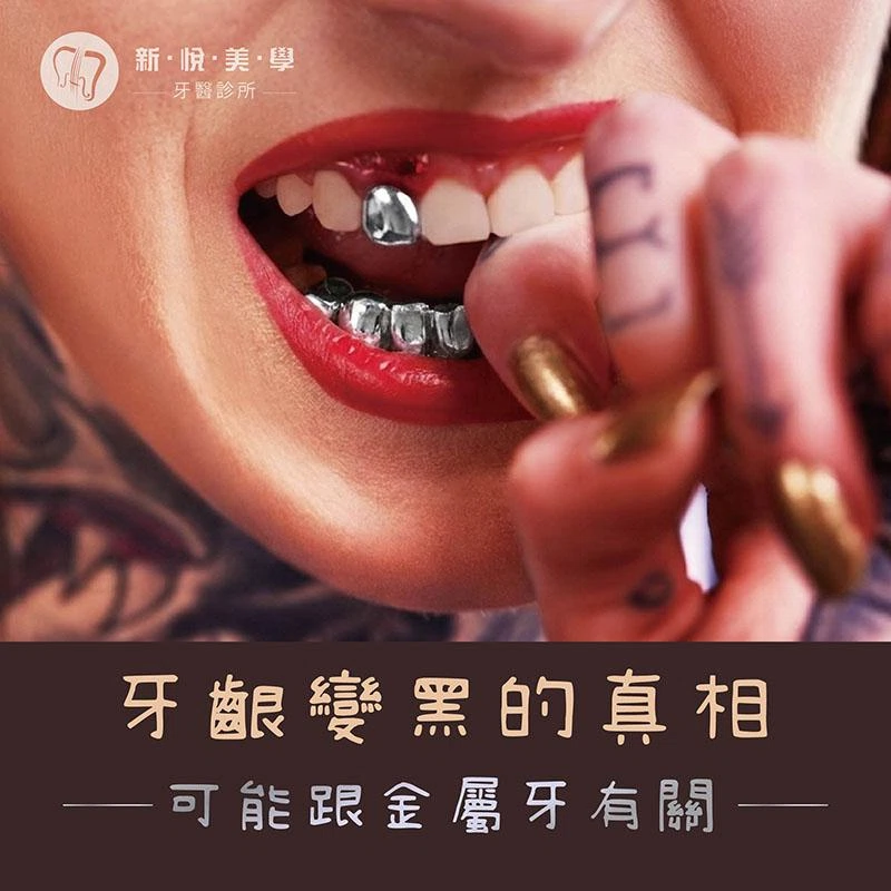 金屬牙套需要更換嗎？牙齦變黑、卡垢與全瓷冠一次看懂