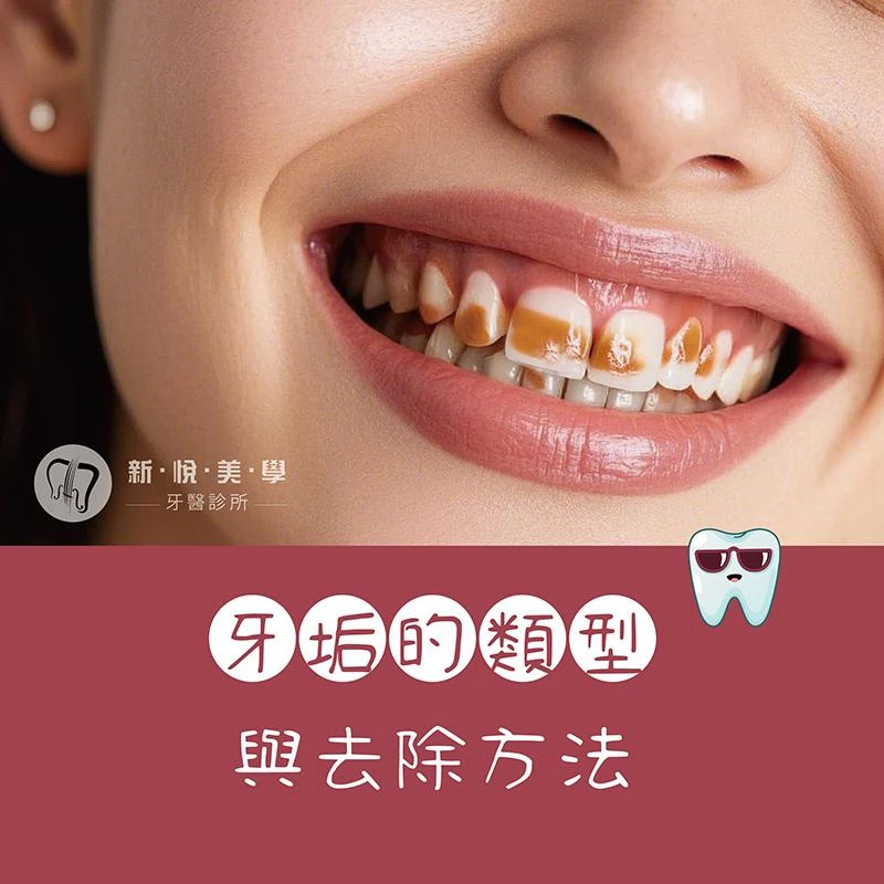 擺脫牙垢的束縛！讓你的牙齒『重見光明』