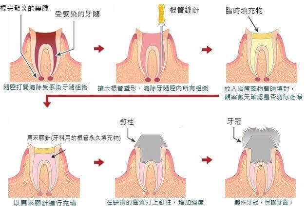 根管治療