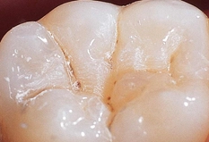 兒童牙科 兒童牙科