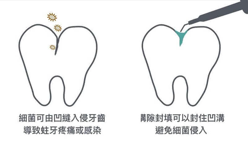 兒童牙科 兒童牙科